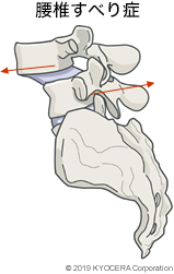 腰椎すべり症