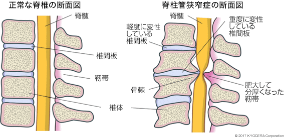 正常な脊椎の断面図 脊柱管狭窄症の断面図