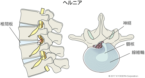 ヘルニア