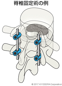 脊椎固定術の例