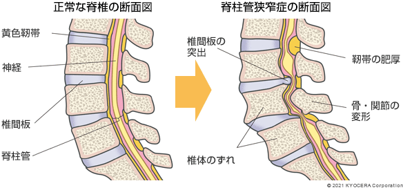 正常な脊椎の断面図 脊柱管狭窄症の断面図