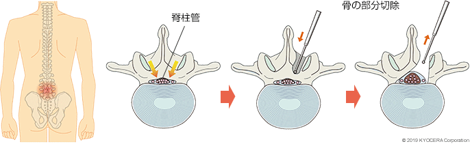 神経の圧迫を解放する手術例