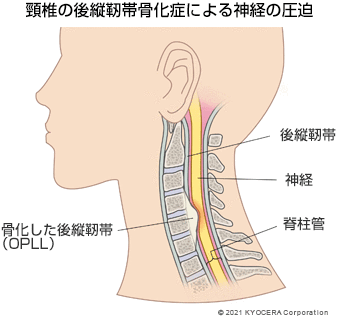 頸椎の後縦靭帯骨化症による神経の圧迫