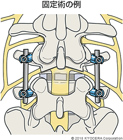 固定術の例