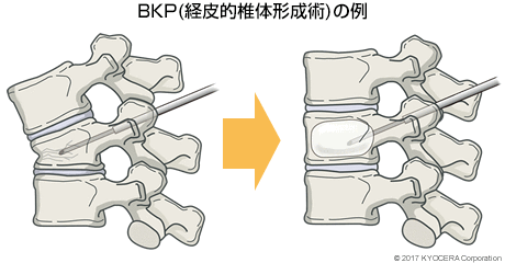 BKP(経皮的椎体形成術)の例