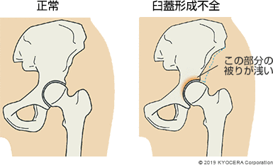 正常 臼蓋形成不全