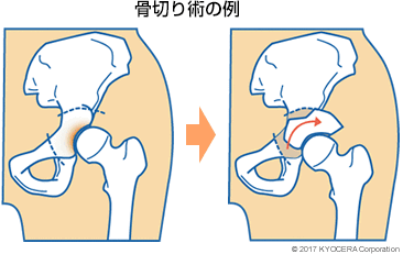 骨切り術の例