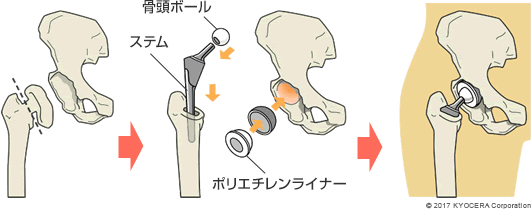 人工股関節置換術