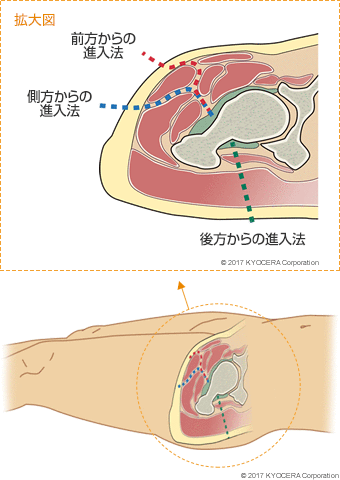 前方からの進入法 側方からの進入法 後方からの進入法