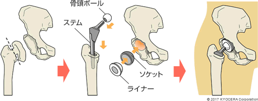 全人工股関節置換術