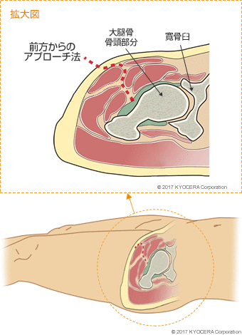 前方からのアプローチ法 大腿骨骨頭部分 寛骨臼