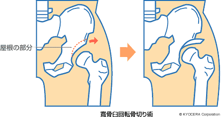 寛骨臼回転骨切り術