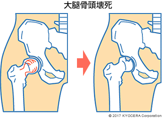 大腿骨頭壊死