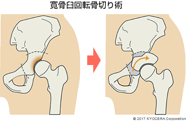 寛骨臼回転骨切り術