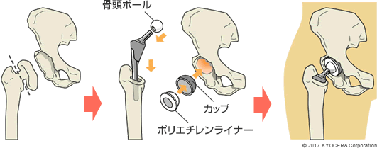 人工股関節置換術の例