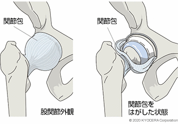 関節包 股関節外観 関節包をはがした状態