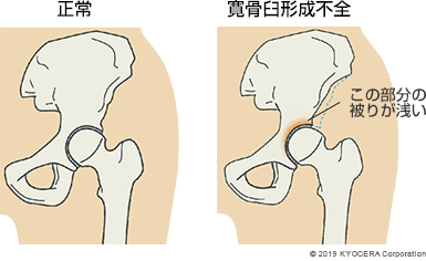 正常 寛骨臼形成不全