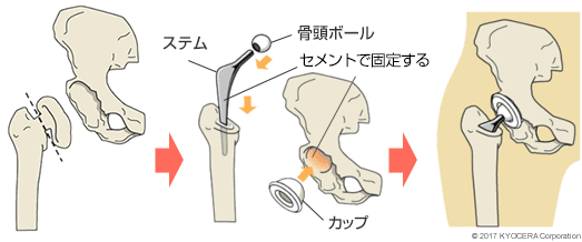 セメントタイプの人工股関節置換術の例