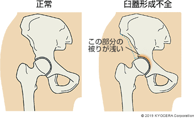 正常 臼蓋形成不全