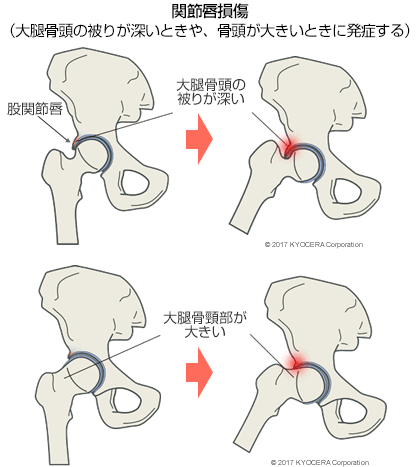 関節唇損傷（大腿骨頭の被りが深いときや、骨頭が大きいときに発症する）