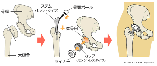 人工股関節置換術の例