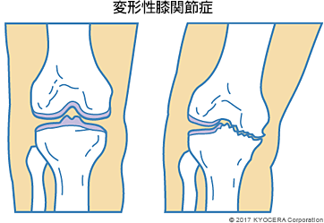 変形性膝関節症