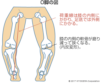 O脚の図