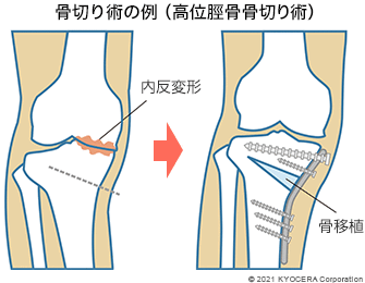 骨切り術の例（高位脛骨骨切り術）