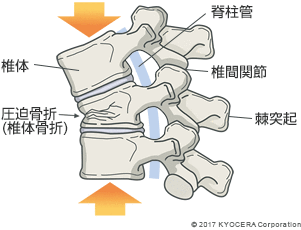 圧迫骨折