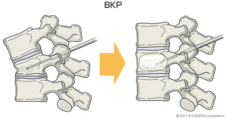 BKP