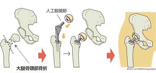 人工骨頭置換術の例