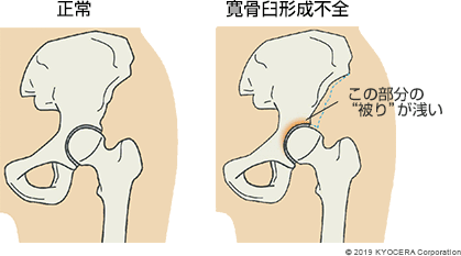 寛骨臼形成不全