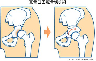 寛骨臼回転骨切り術