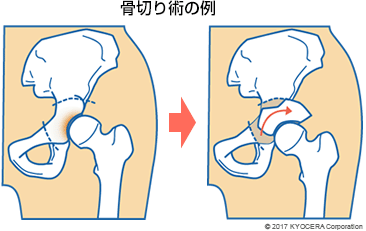 人工股関節置換術の例