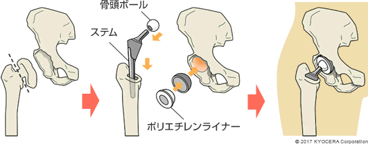 前方からの進入法　側方からの進入法　後方からの進入法（筋肉を切開する必要がある）