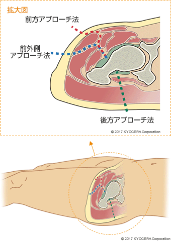 前方アプローチ法　前外側アプローチ法　後方アプローチ法