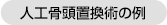 人工骨頭置換術の例