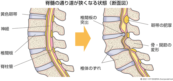 脊髄の通り道が狭くなる状態（断面図）