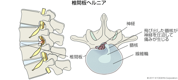 椎間板ヘルニア