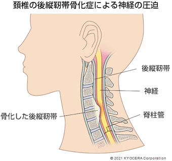 頚椎の後縦靭帯骨化症による神経の圧迫