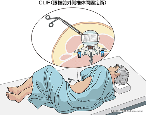 OLIF（腰椎前外側椎体間固定術）