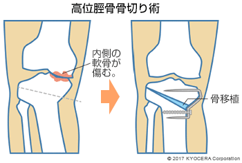 高位脛骨骨切り術