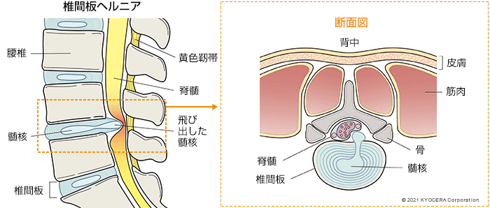 椎間板ヘルニア 断面図