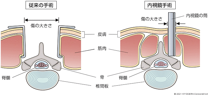 従来の手術 内視鏡手術