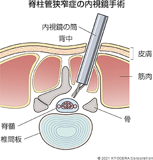 脊柱管狭窄症の内視鏡手術