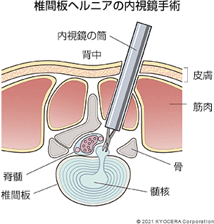 椎間板ヘルニアの内視鏡手術