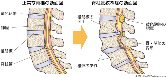 正常な脊椎の断面図 脊柱管狭窄症の断面図