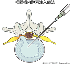 椎間板内酵素注入療法