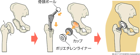 人工股関節全置換術の例