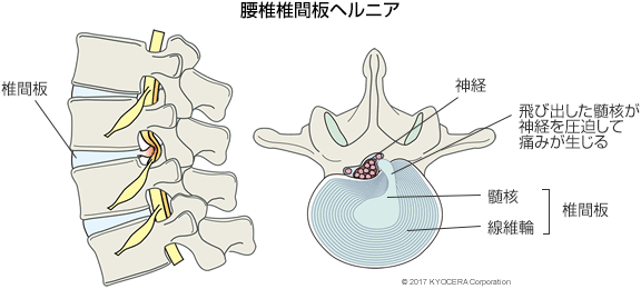 腰椎椎間板ヘルニア